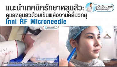 แนะนำเทคนิครักษาหลุมสิว: ดูแลหลุมสิวด้วยเข็มพลังงานคลื่นวิทยุ Infini RF Microneedle